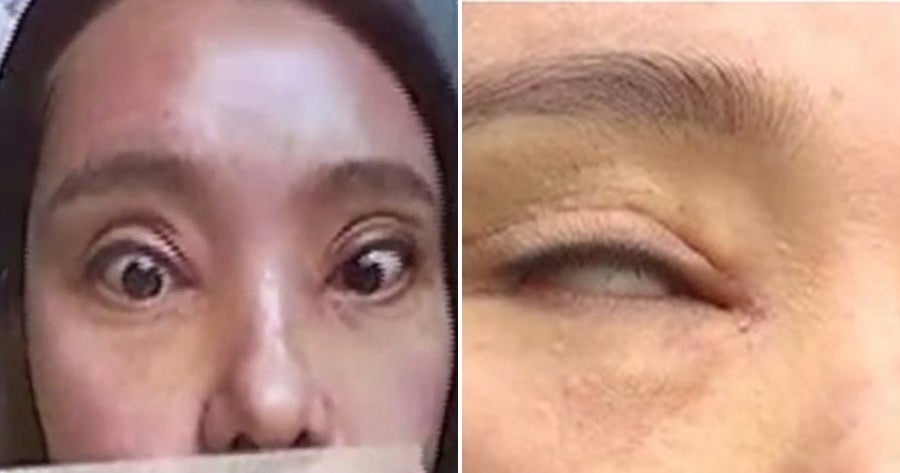 Woman Can't Close Her Eyes Fully After Getting Double Eyelid Surgery Twice - WORLD OF BUZZ