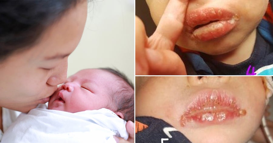 Baby Boy Gets Herpes After A Stranger Who Had A Cold Sore Kissed Him - World Of Buzz