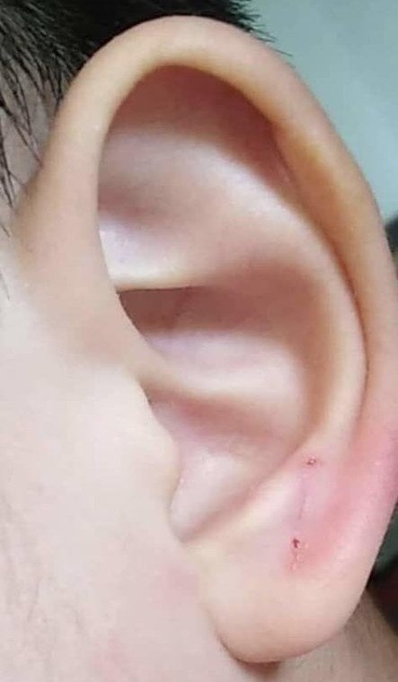 Kuching Kindergarten Teacher Allegedly Staples 4yo Boy's Ear, Principal Only Apologised Without Explanation - WORLD OF BUZZ
