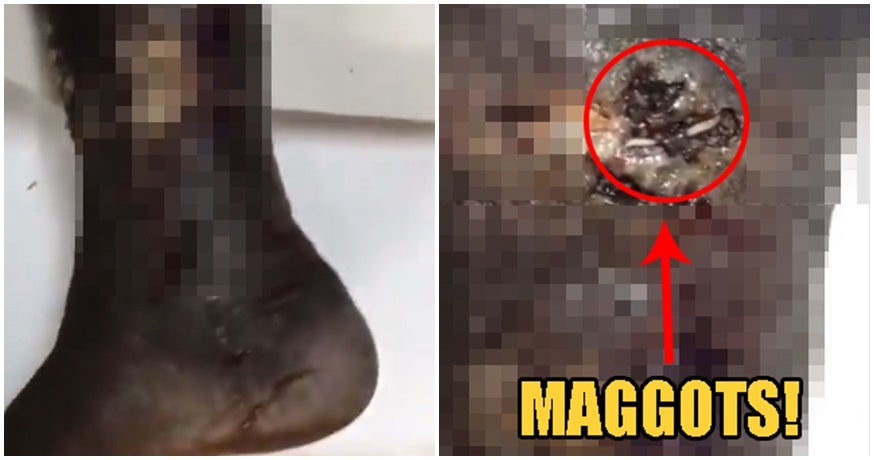 &Quot;Maggots Were Dropping Out&Quot; Says Doctor Who Treated 47Yo M'Sian Diabetic With Rotting Leg - World Of Buzz