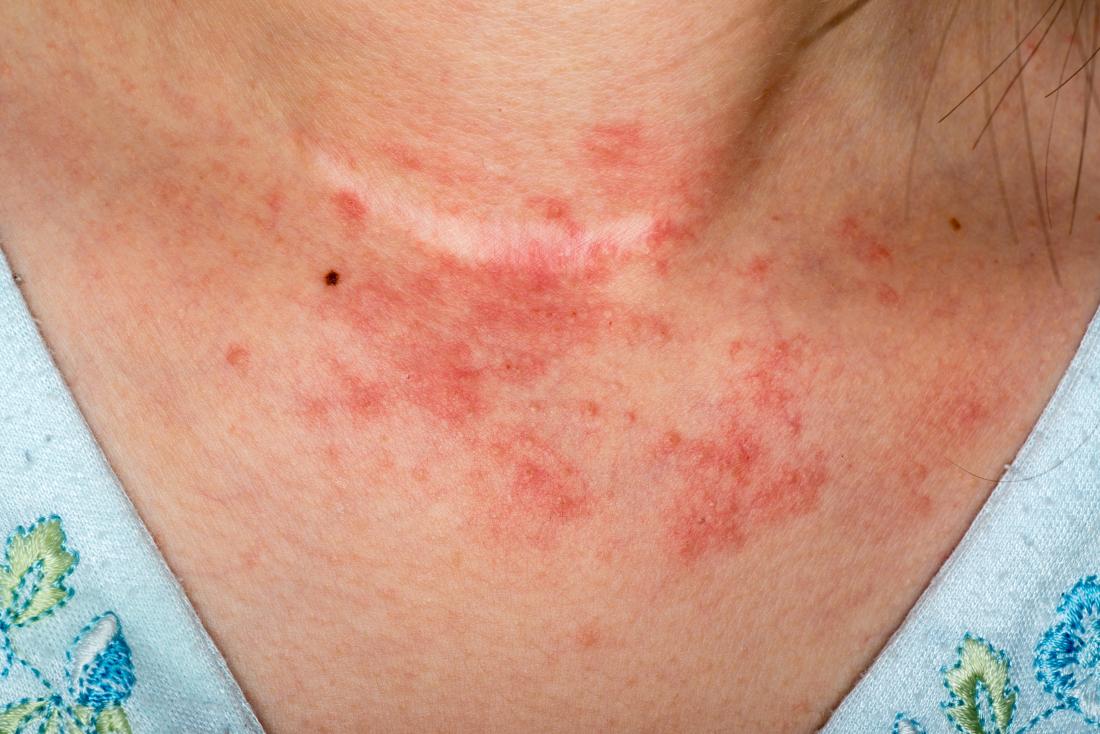 This New Drug Could Provide Relief To Eczema Symptoms Like Redness & Itchy Skin - WORLD OF BUZZ