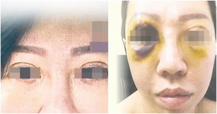 this woman had a double eyelid surgery in a cheras beauty salon and now her right eyeball is damaged world of buzz