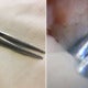 22Yo Man Had A Pair Of Tweezers Inside His Urethra For 4 Years - World Of Buzz
