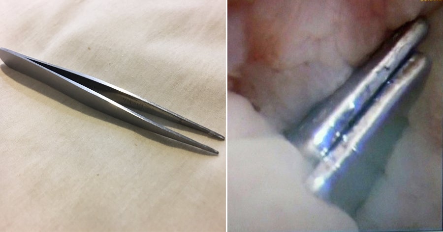 22yo Man Had a Pair of Tweezers Inside His Urethra for 4 YEARS - WORLD OF BUZZ