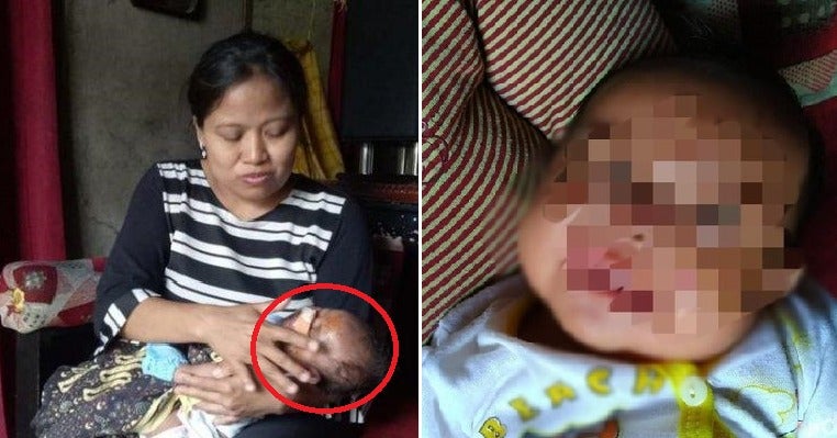 1-Month-Old Baby'S Face Bitten By Huge Rat While Sleeping, Suffers Deep Wounds &Amp; Needs Stitches - World Of Buzz