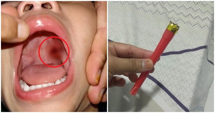 2Yo Johor Toddler Pierces Back Of Her Throat With Party Horn After Tripping On Her Face - World Of Buzz