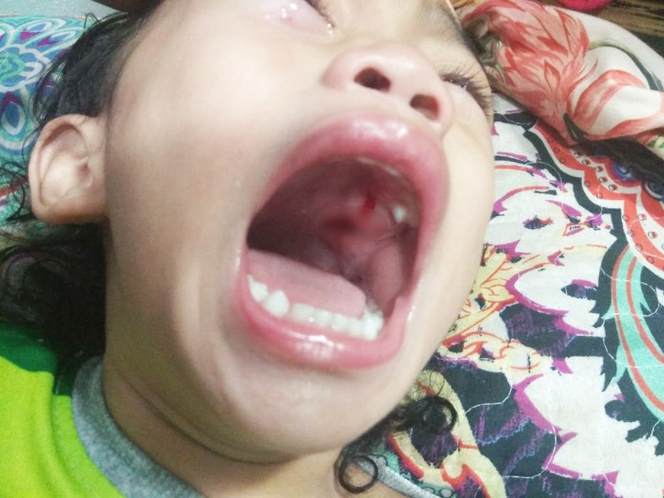 2yo Johor Toddler Stabs The Back of Her Throat After Falling With Party Horn In Her Mouth - WORLD OF BUZZ 2