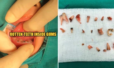 4Yo Has All 20 Baby Teeth Extracted As Irresponsible Parents Didn'T Notice They Were Rotting - World Of Buzz
