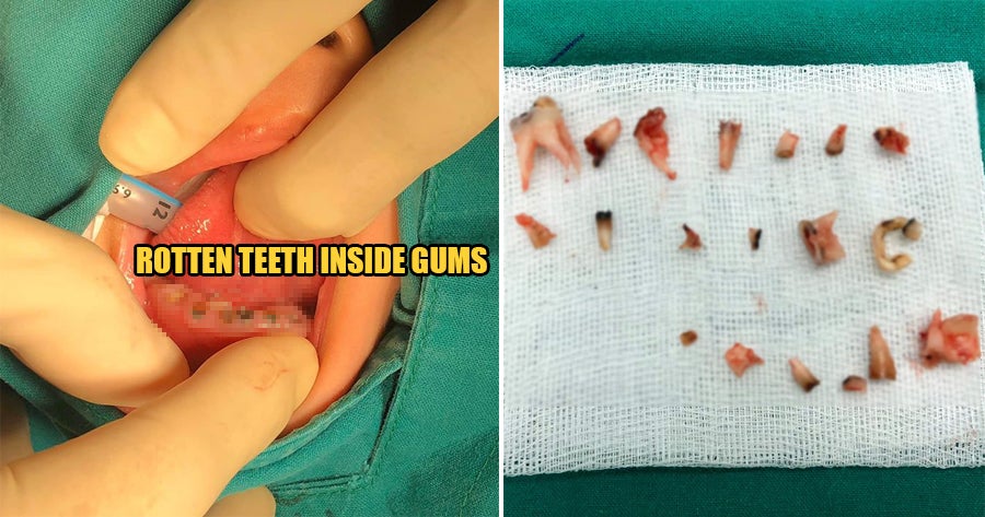 4yo Has All 20 Baby Teeth Extracted As Irresponsible Parents Didn't Notice They Were Rotting - WORLD OF BUZZ