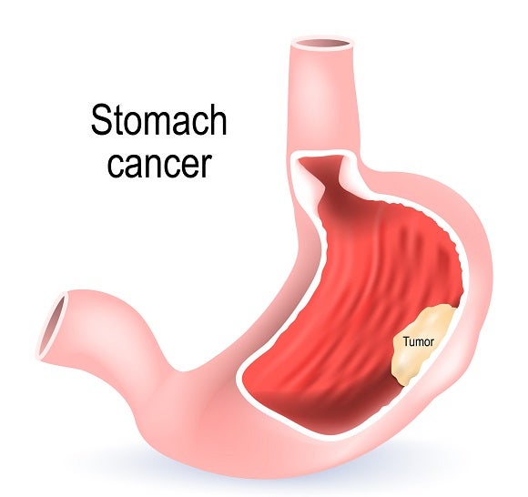 CT Stomach Cancer Resized