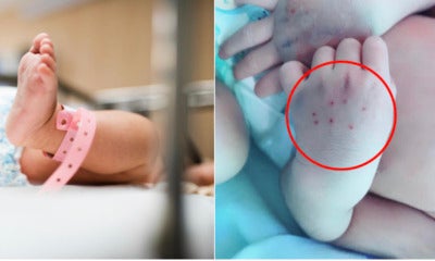 Baby’s Hands Suffered Bruises From 10 Jabs Done By Trainee Doctor To Draw Blood - World Of Buzz 3