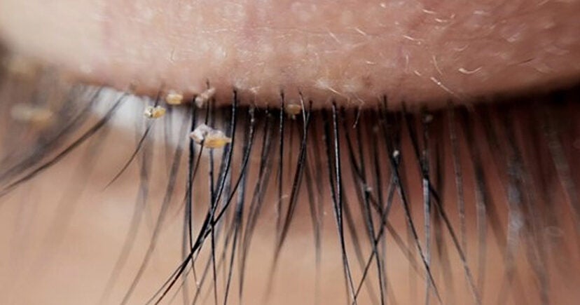 Beware: Doctors Warn Lash Lice Are Becoming More Common In Eyelash Extensions - WORLD OF BUZZ 1
