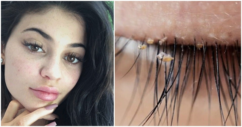 Beware: Doctors Warn Lash Lice Are Becoming More Common In Eyelash Extensions - World Of Buzz 2