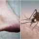 Dengue Can Now Be Transmitted Through Sex, First Case Confirm In Spain - World Of Buzz 2