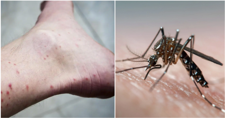 Dengue Can Now Be Transmitted Through Sex, First Case Confirm In Spain - World Of Buzz 2
