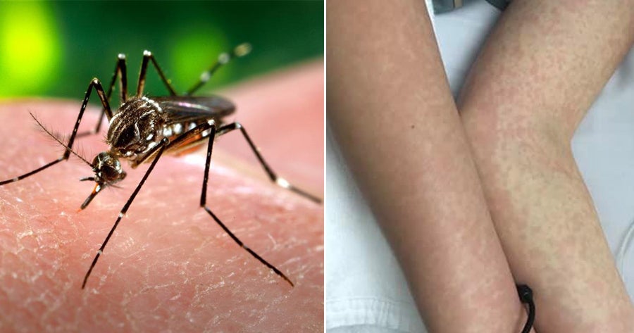 Dengue Can Now Be Transmitted Through Sex, First Case Confirm In Spain - WORLD OF BUZZ