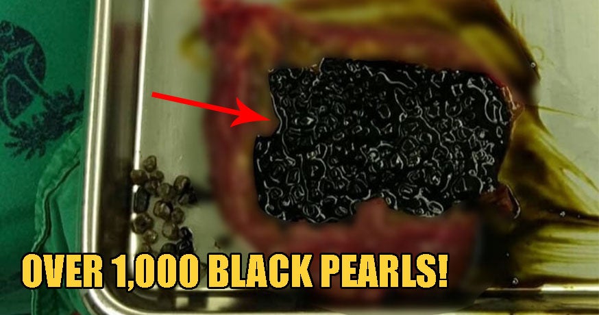 Doctor Finds Over 1,000 'Black Pearls' In 60Yo Man'S Gall Bladder After He Complained Of Stomach Ache - World Of Buzz 1