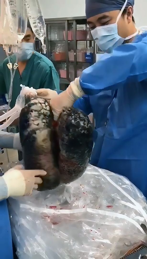 Images Of Man's Lungs Heavily Blackened By 30 Years Of Smoking A Pack A Day Go Viral - World Of Buzz 1