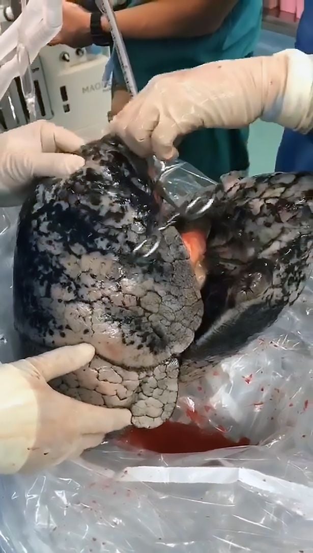Images of Man's Lungs Heavily Blackened By 30 Years of Smoking A Pack A Day Go Viral - WORLD OF BUZZ 2