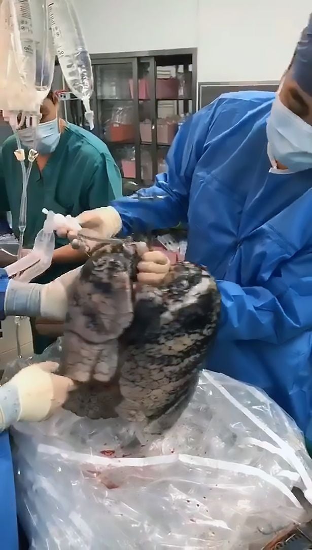Images of Man's Lungs Heavily Blackened By 30 Years of Smoking A Pack A Day Go Viral - WORLD OF BUZZ