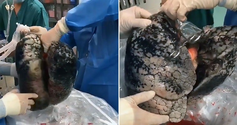 Images Of Man'S Lungs Heavily Blackened By 30 Years Of Smoking One Pack A Day Go Viral - World Of Buzz 1