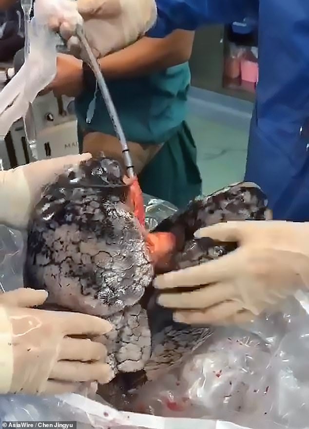 Images of Man's Lungs Heavily Blackened By 30 Years of Smoking One Pack A Day Go Viral - WORLD OF BUZZ