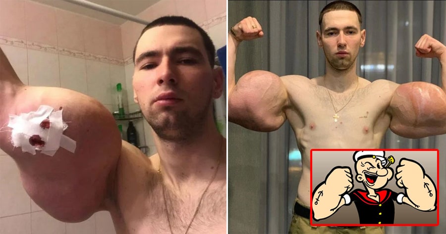23Yo Injects 3 Litres Of Petroleum Jelly Into Muscles To Bulk Up Biceps &Amp; Triceps Like Popeye The Sailor Man - World Of Buzz