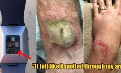 Man Shares How His Fitbit Watch Gave Him Third-Degree Burns When The Battery Overheated - World Of Buzz