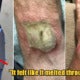 Man Shares How His Fitbit Watch Gave Him Third-Degree Burns When The Battery Overheated - World Of Buzz