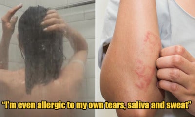 This 21Yo Girl Is Literally Allergic To Water &Amp; Breaks Out In Rashes And Fever If She Showers - World Of Buzz