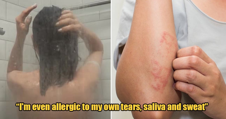This 21Yo Girl Is Literally Allergic To Water &Amp;Amp; Breaks Out In Rashes And Fever If She Showers - World Of Buzz
