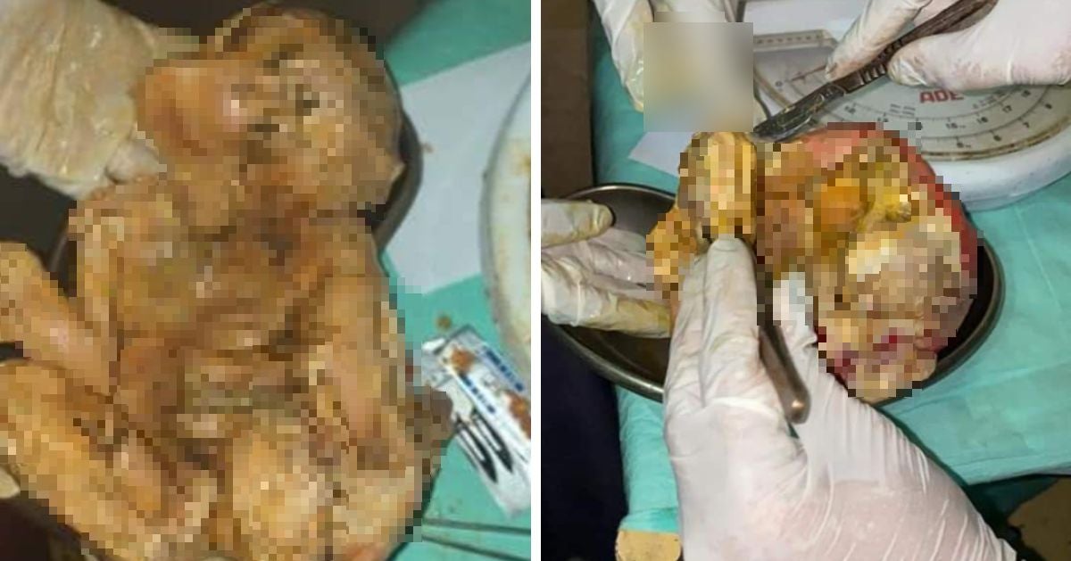 Woman Who Complained Of Abdominal Pains Discovers Dead Baby That Was Inside For 15 Years - World Of Buzz