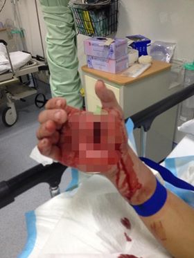 18yo Perak Boy Gets Slashed After Fighting 2 Bold Robbers Who Woke Him Up By Turning On The Lights - WORLD OF BUZZ 2