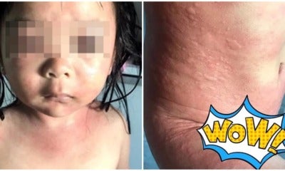 5Yo Girl Suffers Painful Chlorine Burns After Swimming In Freshly Cleaned Swimming Pool - World Of Buzz