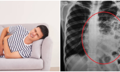 Man Undergoes Surgery After Playful Slap From Gf Causes Intestines To Move Into Chest - World Of Buzz