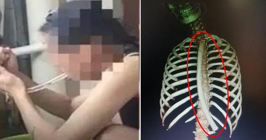 22Yo Woman Accidentally Swallows 30Cm Long Tube After Using It To Make Herself Vomit To Lose Weight - World Of Buzz