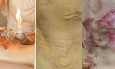 34Yo Woman'S Skin Catches Fire After Fire Cupping Session, Suffers Second-Degree Burns - World Of Buzz