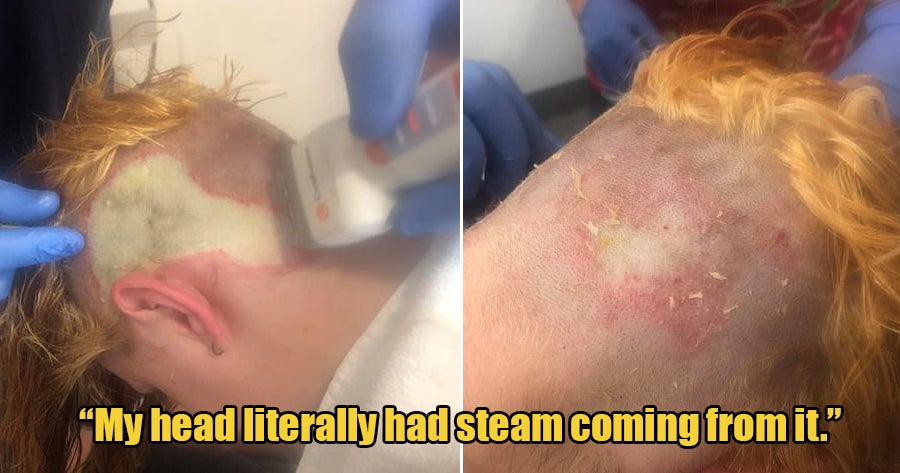 20yo Woman Suffered Third Degree Chemical Burns After Bleaching Her Own Hair to Save Money - WORLD OF BUZZ