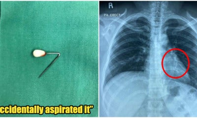 M'Sian Women Had A Headscarf Pin Stuck In Her Lung - World Of Buzz 11