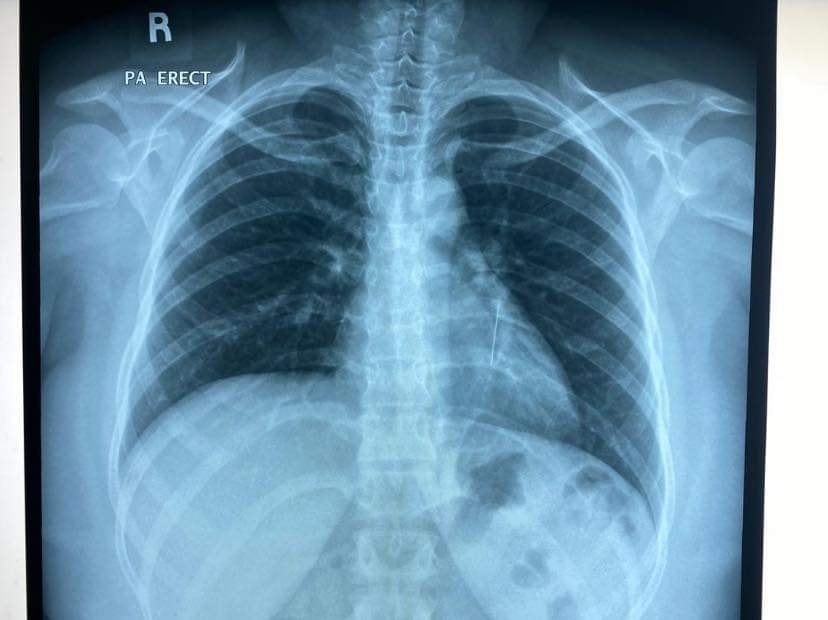 M'sian Women Had A Headscarf Pin Stuck In Her Lung - WORLD OF BUZZ 4