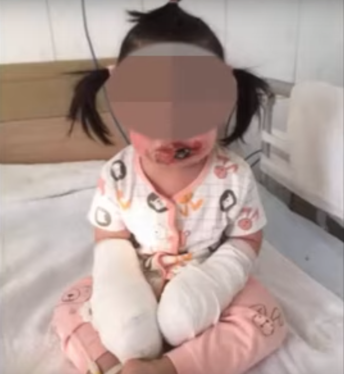 2Yo Girl Suffers 4Th Degree Burns After Negligent Mother Didn't Notice Her Playing With Electric Sockets - World Of Buzz