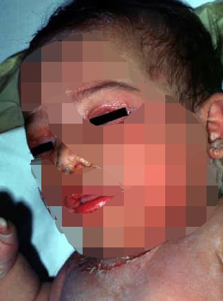 M'sian Doctor Shares How Anti-Vaxxer Parents Caused Baby To Be Covered in Terrible Pus-Filled Sores - WORLD OF BUZZ 1