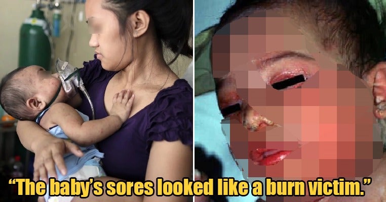 M'Sian Doctor Shares How Anti-Vaxxer Parents Caused Baby To Be Covered In Terrible Pus-Filled Sores - World Of Buzz 6
