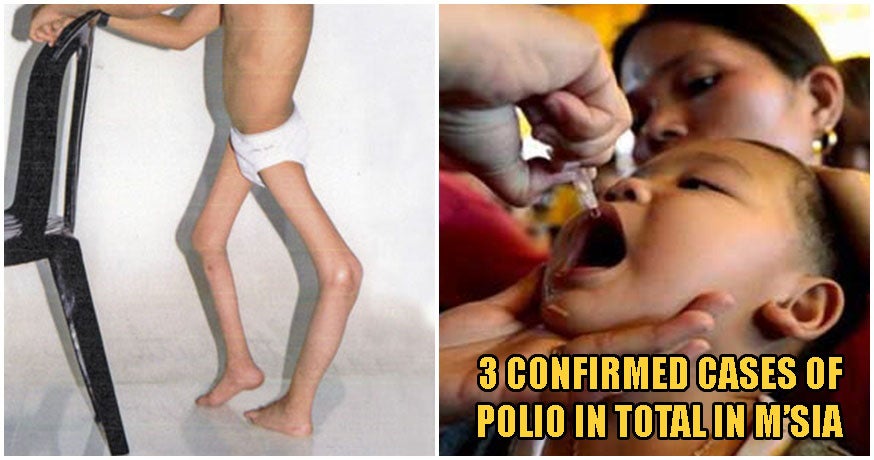 Warning: 2 More Cases of Polio Have Been Confirmed In Sabah According to MoH - WORLD OF BUZZ