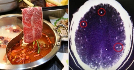 Woman Feels Pain in Her Throat & Chest After Having Hotpot, Coughs Up Blood The Next Day - WORLD OF BUZZ 2
