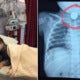 M'Sian Mum Shares How She Had To Wait Almost 24Hrs Before A 20Sen Coin In Son'S Throat Was Removed - World Of Buzz