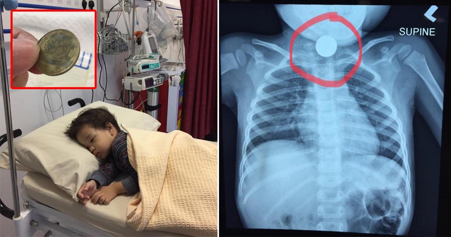 M'Sian Mum Shares How She Had To Wait Almost 24Hrs Before A 20Sen Coin In Son'S Throat Was Removed - World Of Buzz