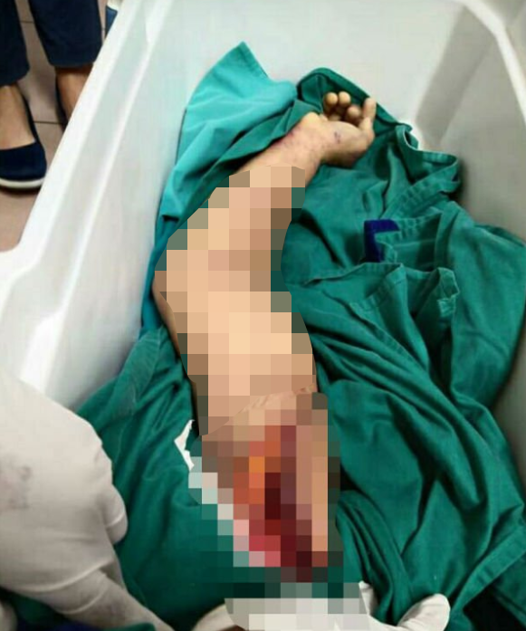 51yo Penang Man's Arm Gets Horrifically Ripped Off While Moving Heavy Machinery At Paper Mill - WORLD OF BUZZ 1
