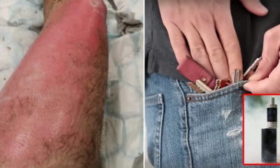 37Yo Man Gets Third-Degree Burns After His Vape Rubbed Against Metal Keys In Pocket &Amp; Exploded After It Rubbed Against Metal Keys In His Pocket, - World Of Buzz