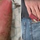 37Yo Man Gets Third-Degree Burns After His Vape Rubbed Against Metal Keys In Pocket &Amp; Exploded After It Rubbed Against Metal Keys In His Pocket, - World Of Buzz